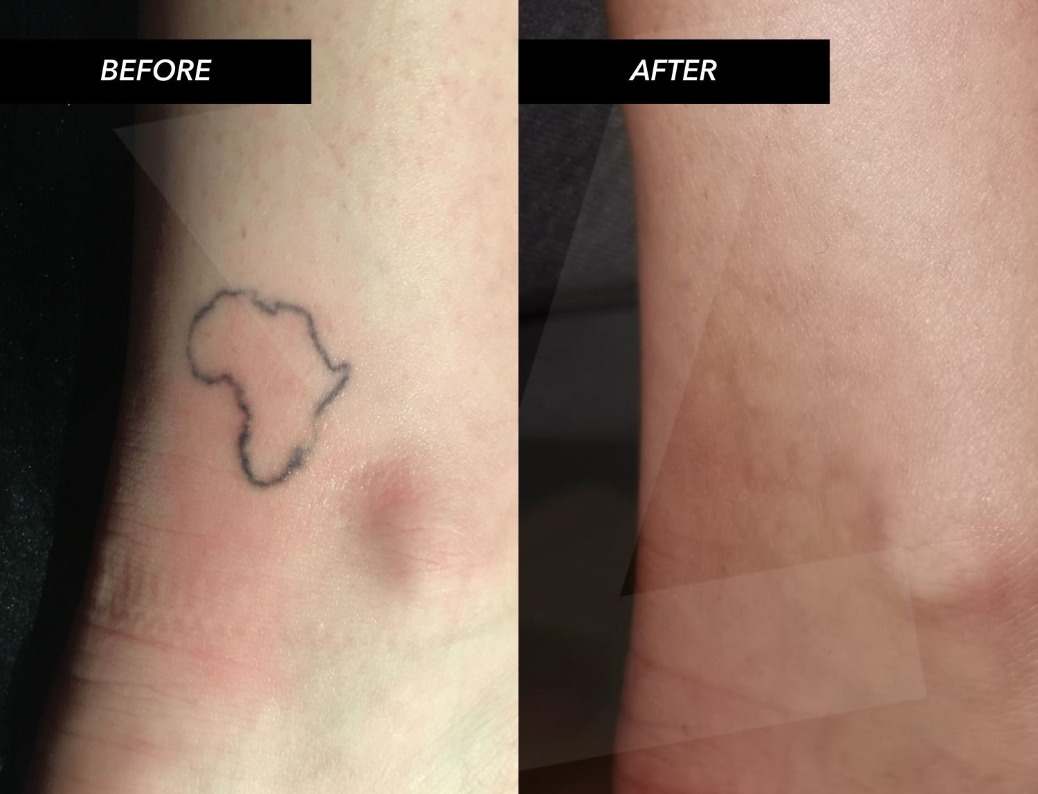 Tattoo removal B&A 4
